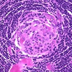 Castleman Workshop 2025